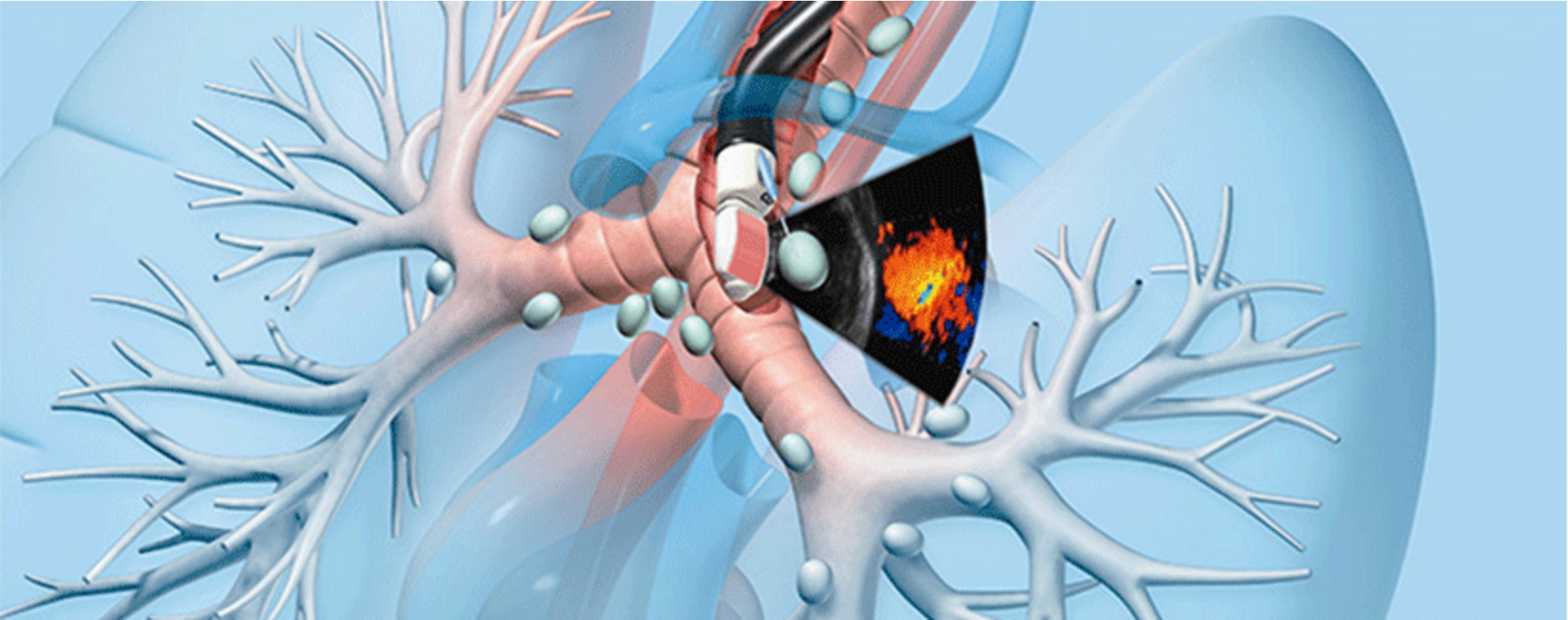 Endobronchial Ultrasonography (EBUS)