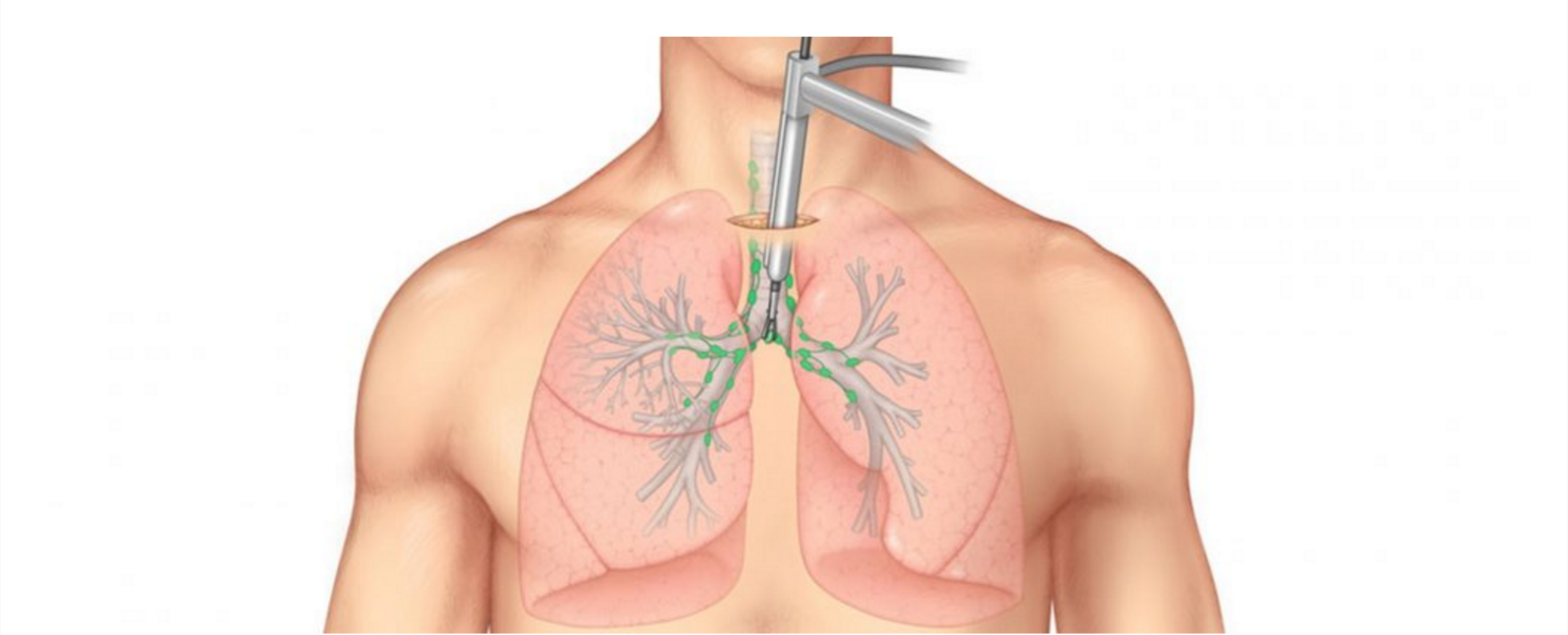 Mediastinoscopy