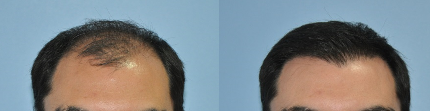 Hair Transplantation Center