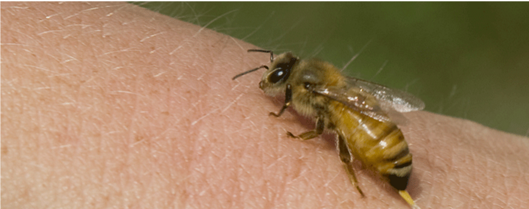 Bee Allergy