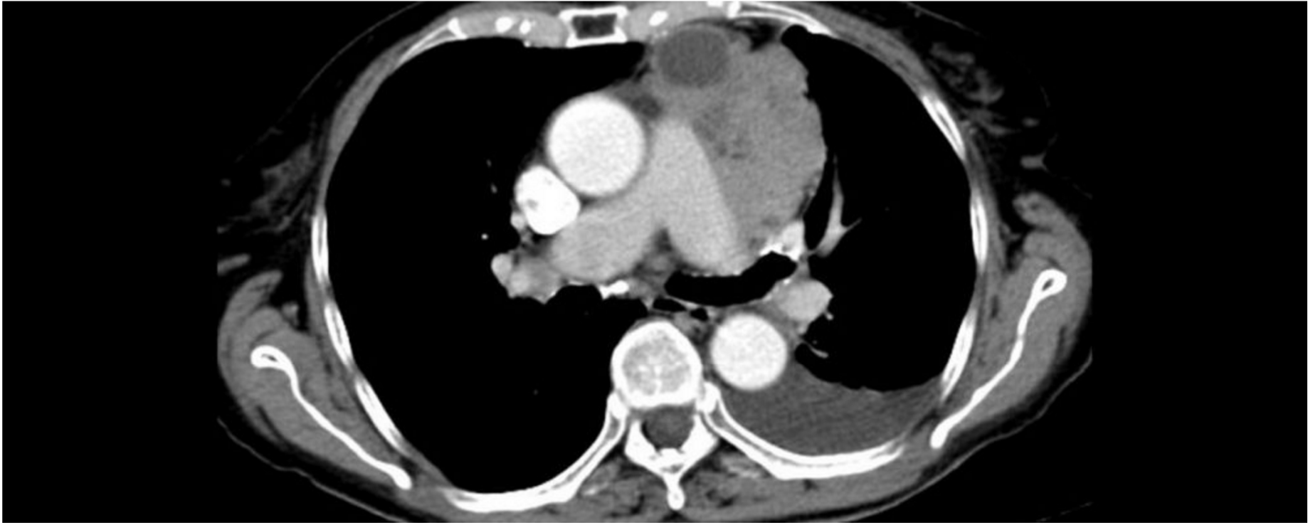 Thymoma and Mediastinal Pathologies