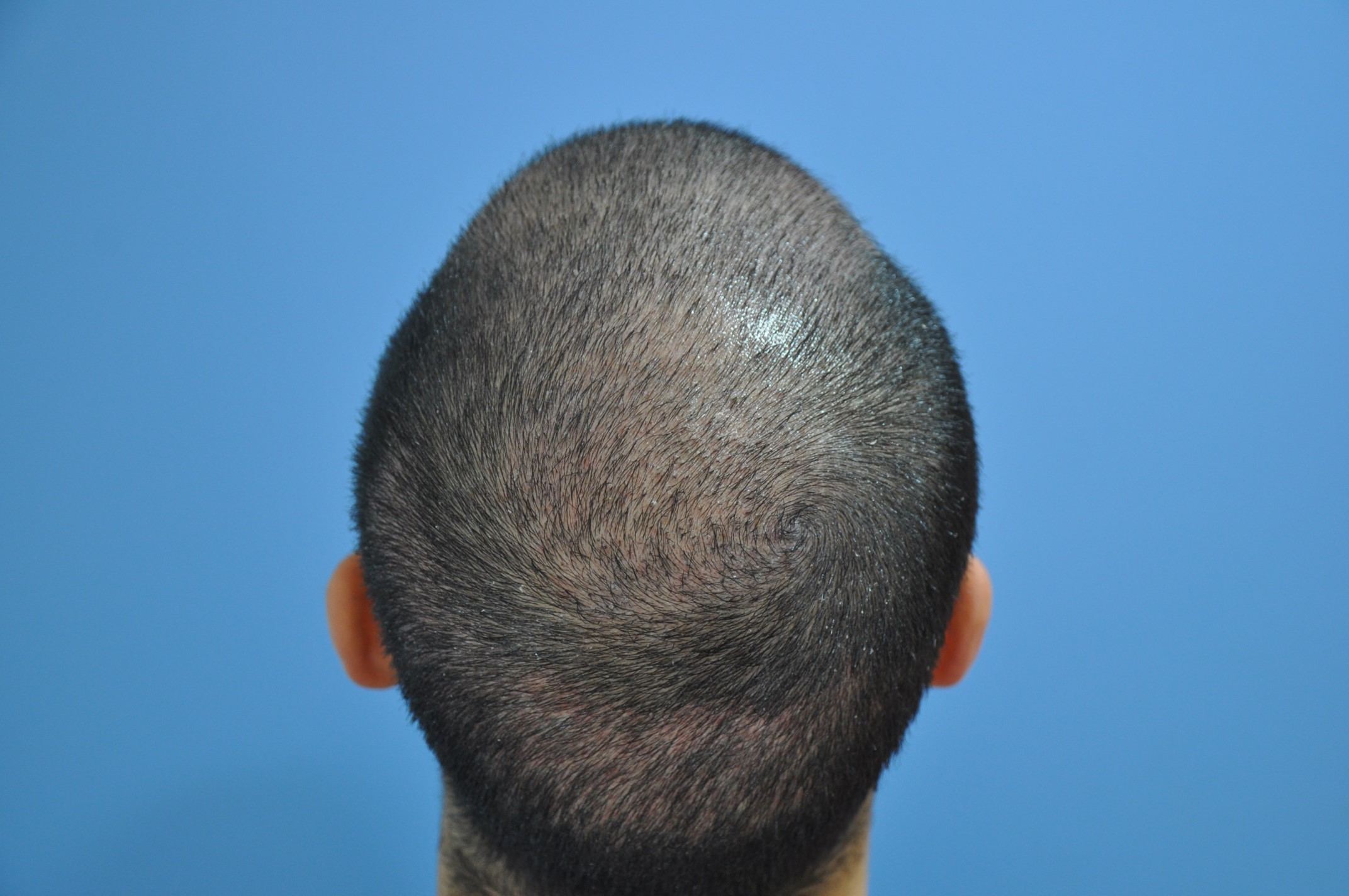 Hair Transplantation Center